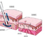 美容针的危害和副作用