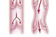 下肢静脉曲张的症状表现